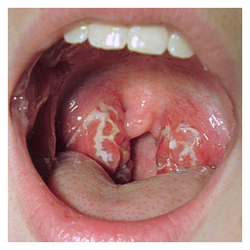 علائم سوزاک در دهان