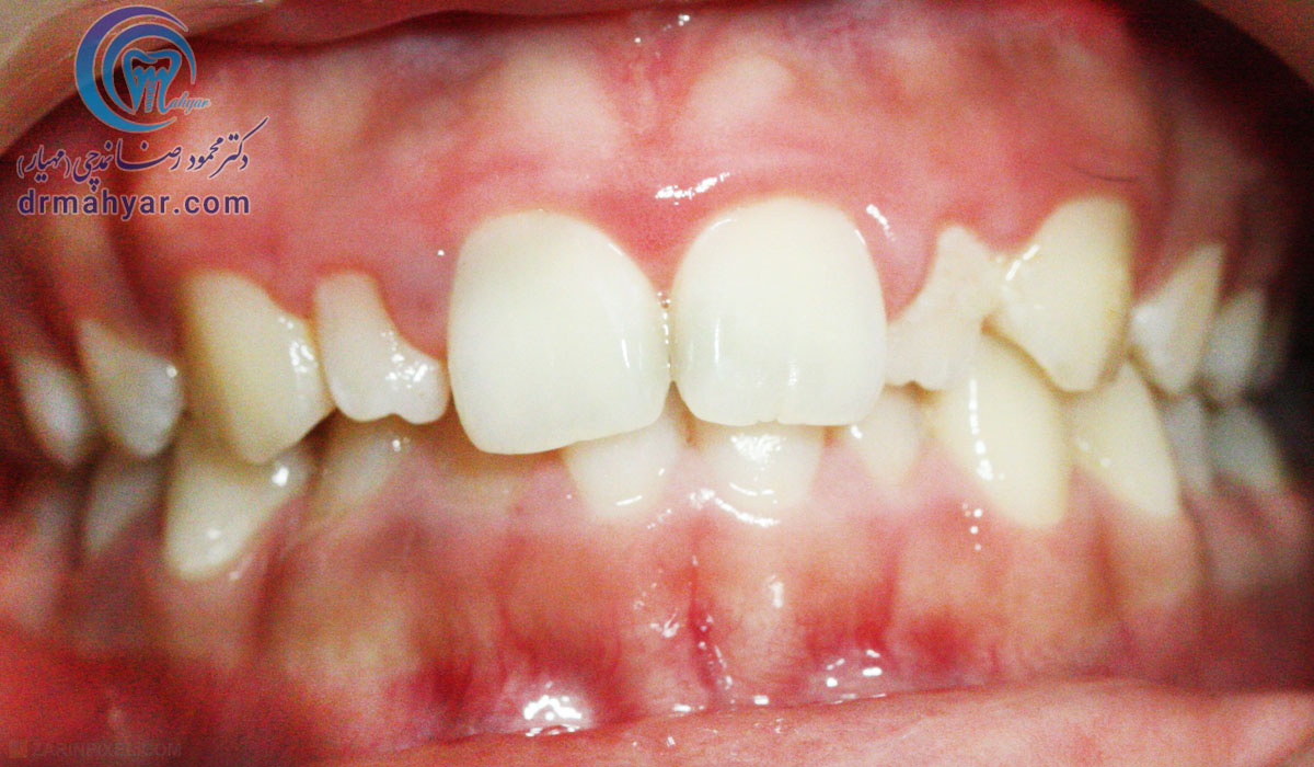 دندان (دندان های) کوچک تر از اندازه طبیعی