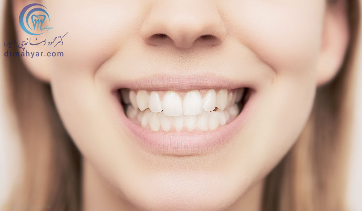اصلاح لبخند لثه ای (لثه نمایان) با نوروتوکسین بوتاکس