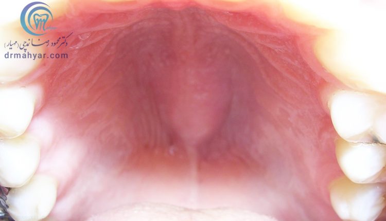برجستگی خوش خیم استخوانی در سقف دهان