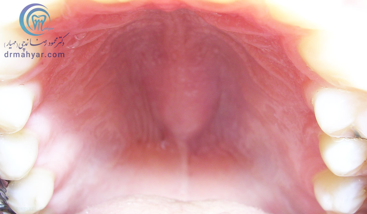 برجستگی خوش خیم استخوانی در سقف دهان