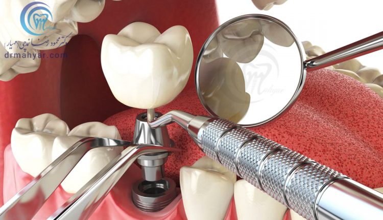 جایگذاری فوری ایمپلنت پس از کشیدن دندان
