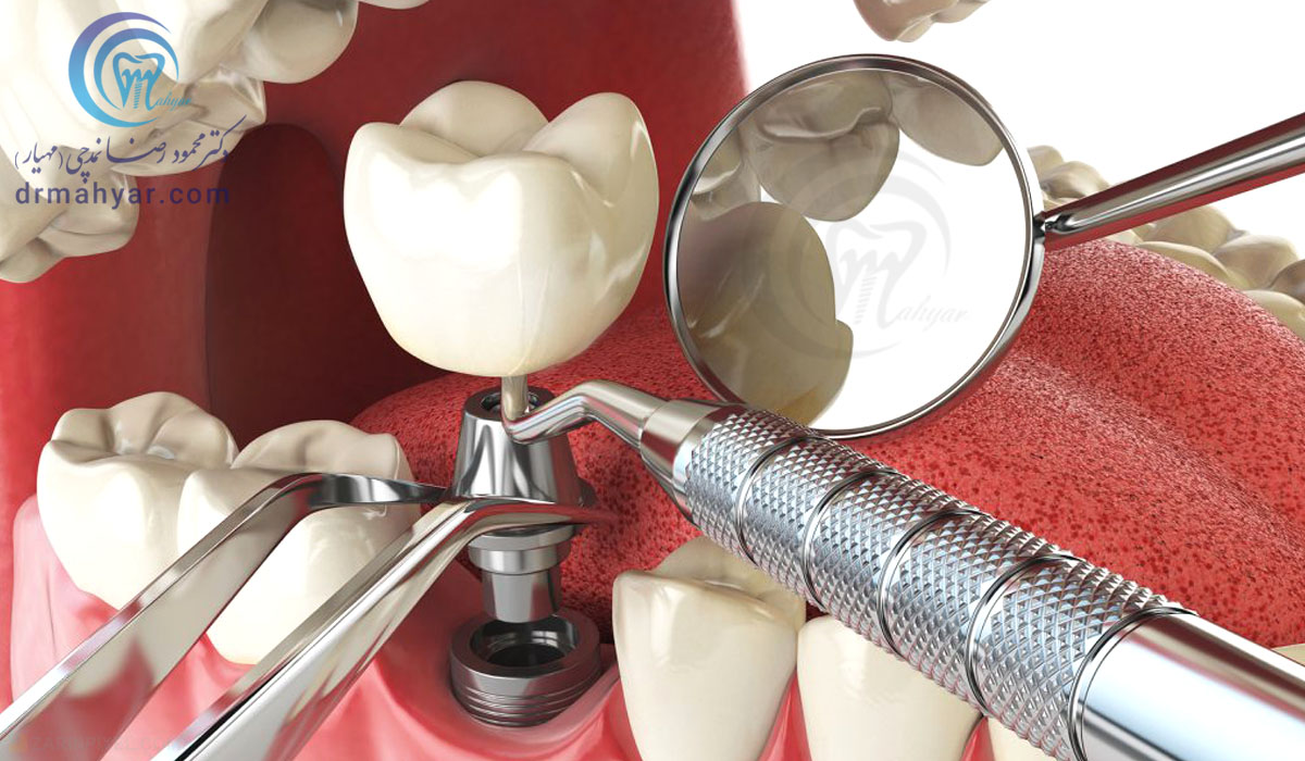 جایگذاری فوری ایمپلنت پس از کشیدن دندان