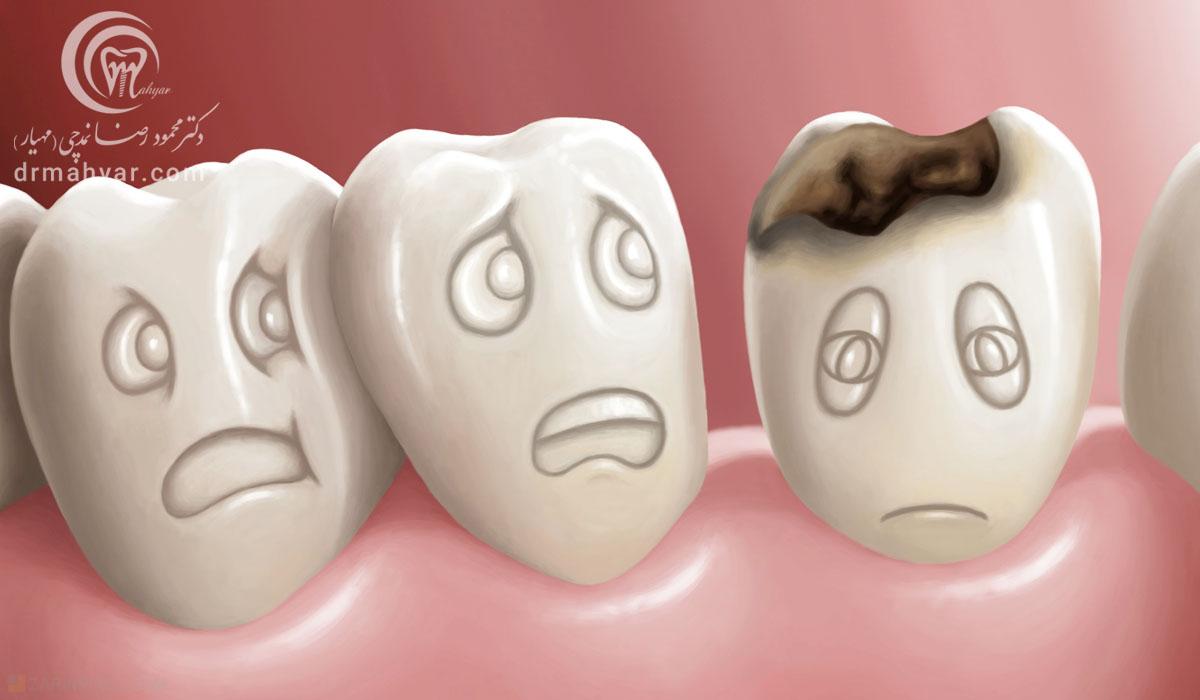 پوسیدگی دندان و چگونگی شکل گرفتن آن