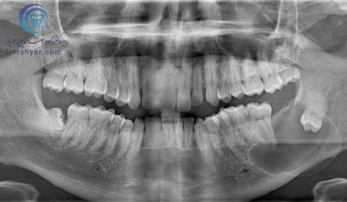 کیست فولیکولار ( ارتباط آن با دندان عقل نهفته )