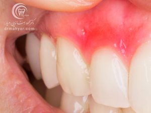 آبسه دندان (عفونت دندان) ، علائم و درمان آن