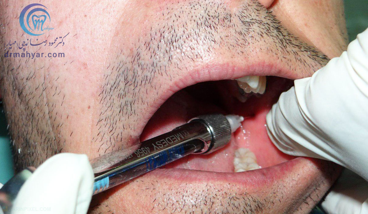محدودیت باز کردن فک پس از تزریق دندان پزشکی