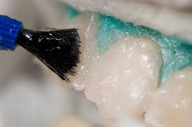 ژل بلیچینگ - سفید کردن دندان در خانه