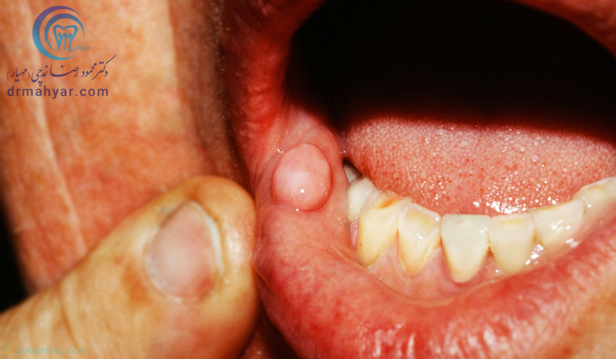 فیبروم یا فیبروما در دهان