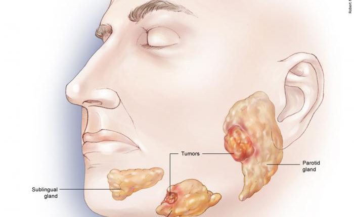 jaws tumor-stage-2-drmahyar