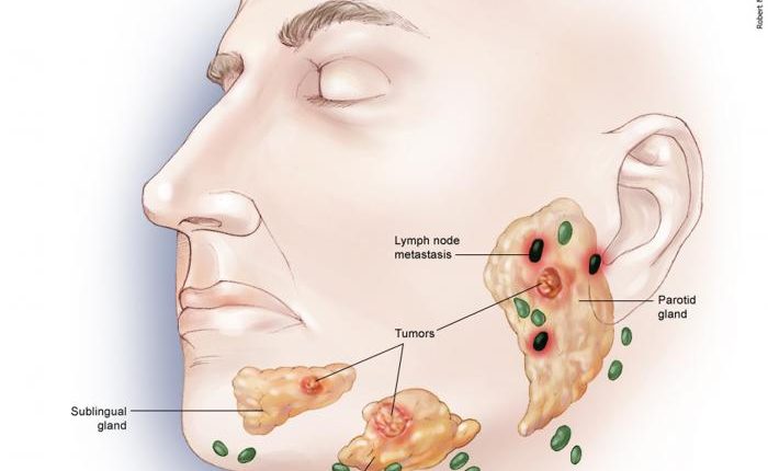 jaws tumor-stage-3-drmahyar