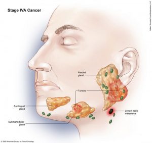 سرطان فک مرحله چهارم