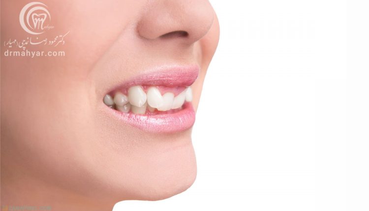عوارض ناشی از رویش نابجای دندانی