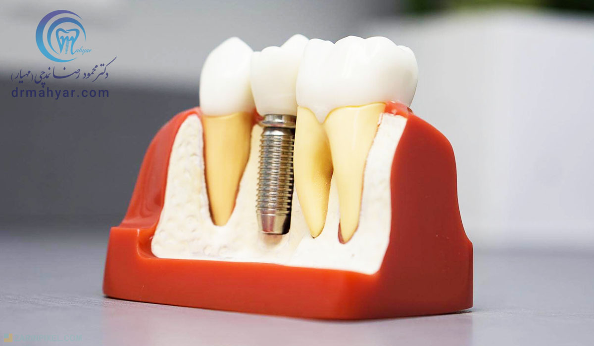 مزایای ایمپلنت فوری بلافاصله پس از کشیدن دندان