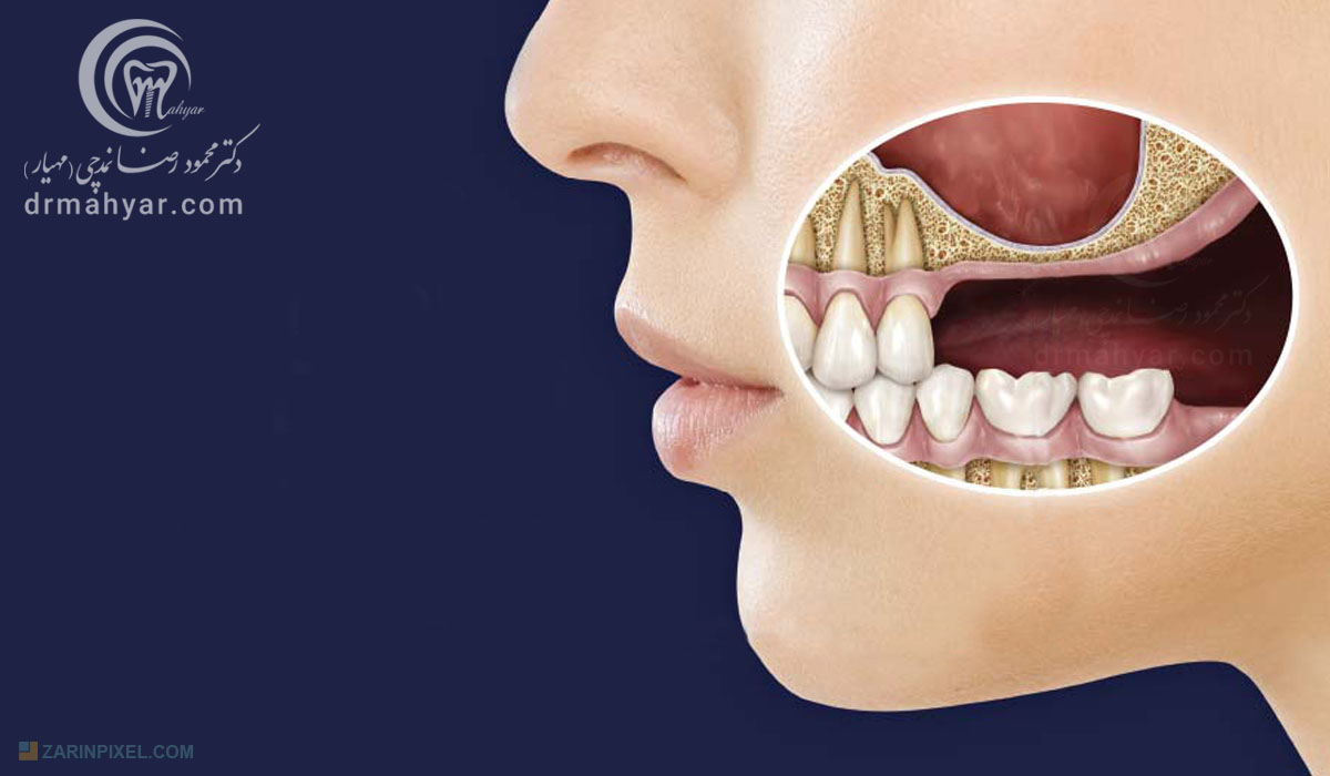 التهاب و عفونت سینوس با منشا دندانی
