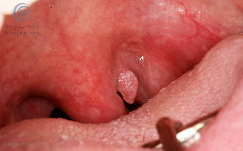 Genital Warts in dental - زگیل تناسلی در دهان و دندان