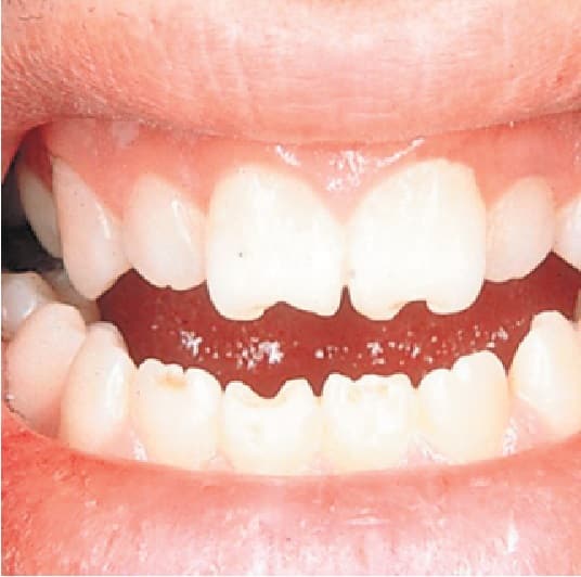 هیپوپلازی سیفلیسی - دندان هوچینسون