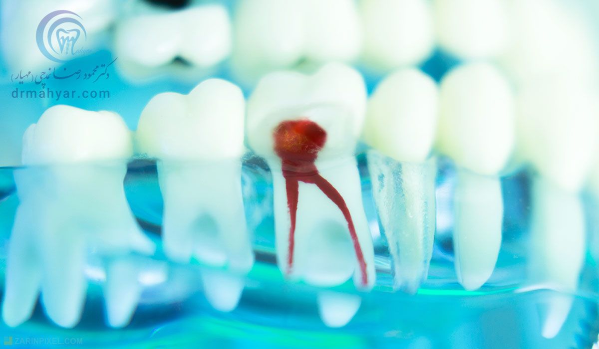 هر آنچه باید در مورد عصب کشی دندان بدانید