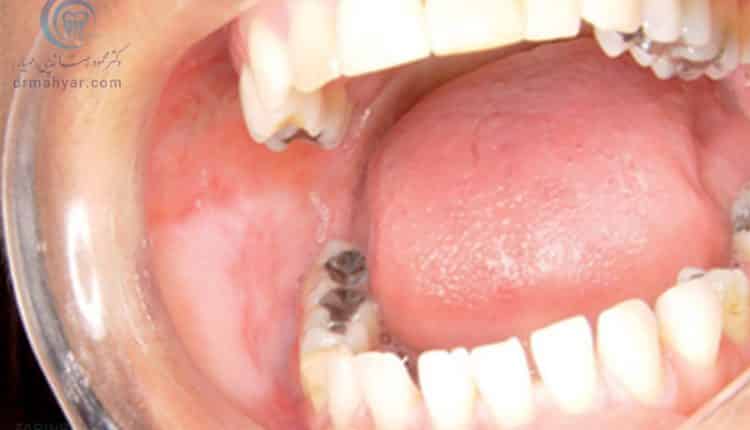 لکوپلاکیا لکه های سفید در دهان و روی زبان