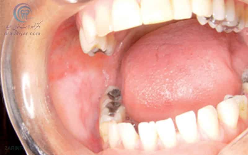 لکوپلاکیا لکه های سفید در دهان و روی زبان
