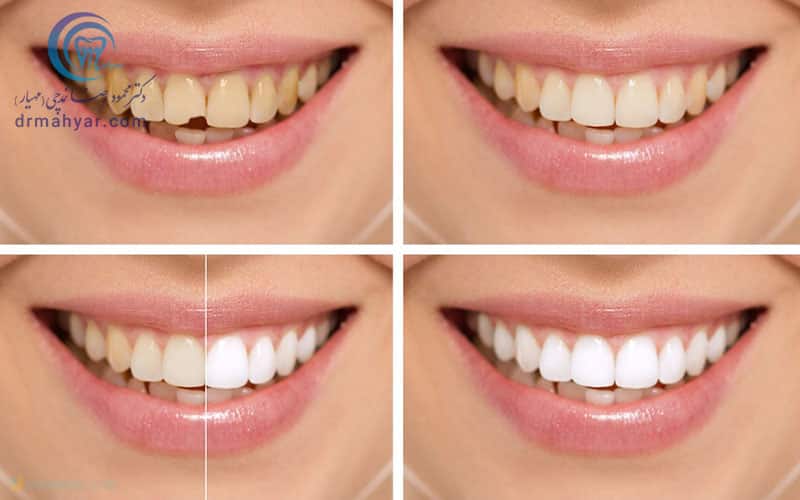 قبل و بعد باندینگ دندان