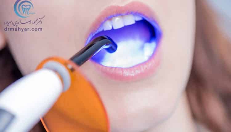 باندینگ دندانپزشکی